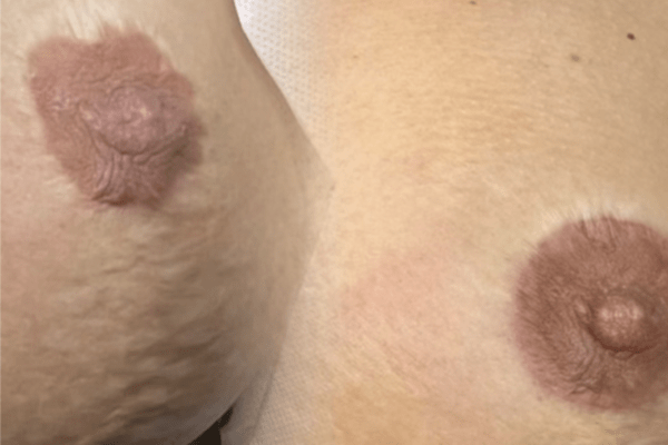 Areola restoration